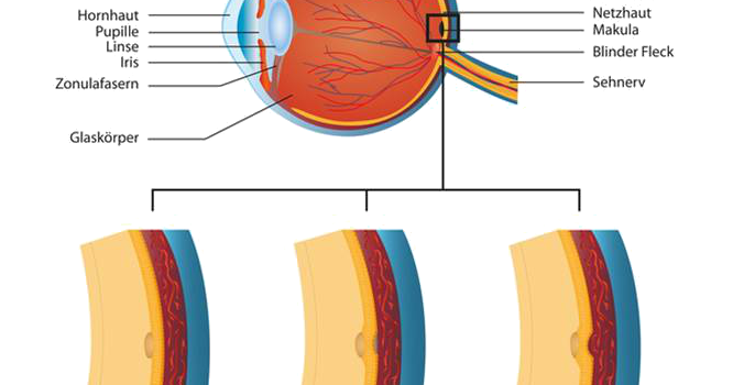 Makuladegeneration – Therapie bei Makuladegeneration