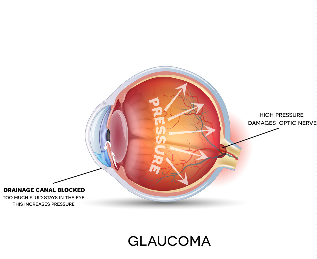 Глазное давление у детей. Глаукома это простыми словами. Глаукома этиология.