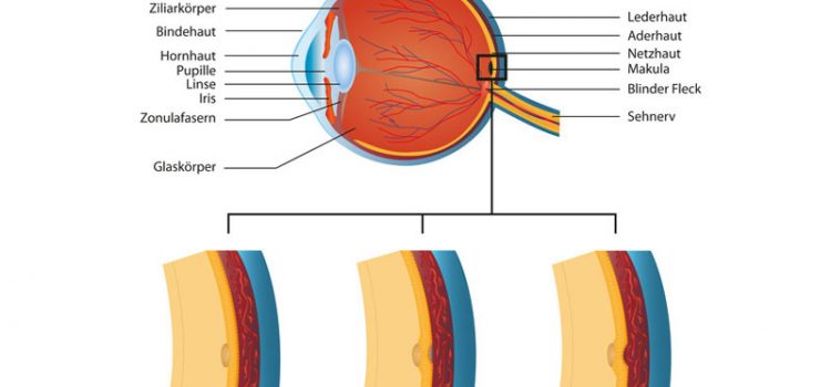 Maculadegeneration – Vorbeugung